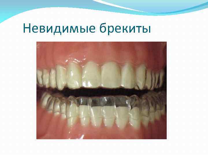 Невидимые брекиты 