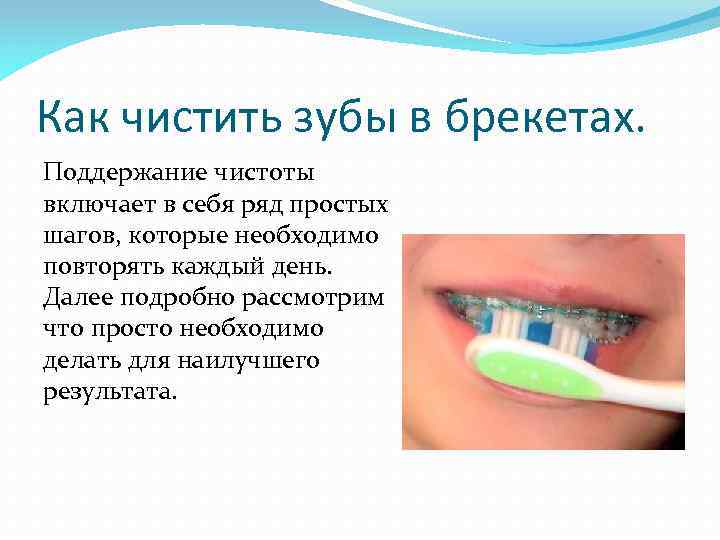 Как чистить зубы в брекетах. Поддержание чистоты включает в себя ряд простых шагов, которые