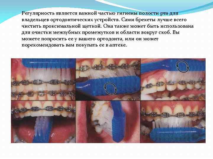 Регулярность является важной частью гигиены полости рта для владельцев ортодонтических устройств. Сами брекеты лучше