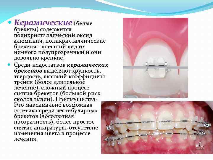  Керамические (белые брекеты) содержится поликристаллический оксид алюминия, поликристаллические брекеты - внешний вид их