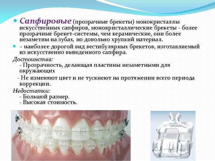  Сапфировые (прозрачные брекеты) монокристаллы искусственных сапфиров, монокристаллические брекеты - более прозрачные брекет-системы, чем
