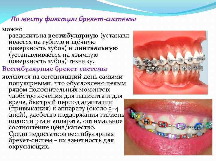 По месту фиксации брекет-системы можно разделитьна вестибулярную (устанавл ивается на губную и щёчную поверхность