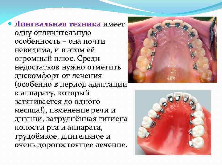  Лингвальная техника имеет одну отличительную особенность – она почти невидима, и в этом