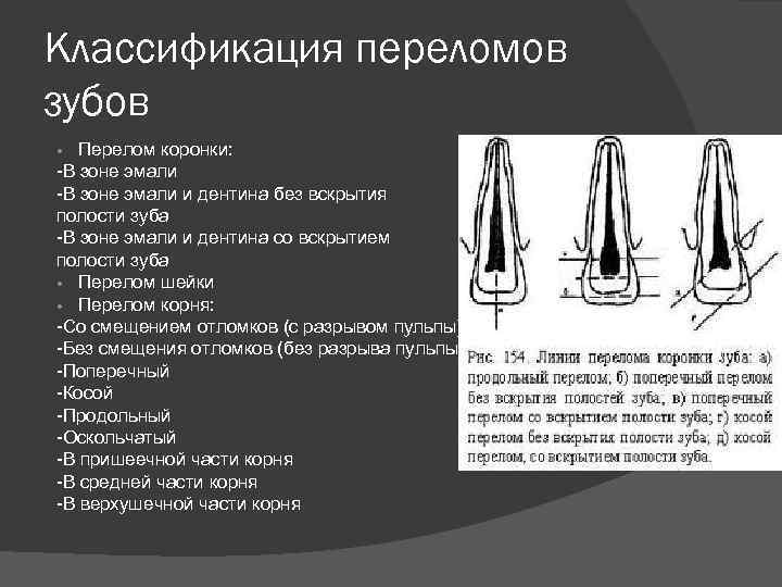 Классификация переломов зубов Перелом коронки: -В зоне эмали и дентина без вскрытия полости зуба