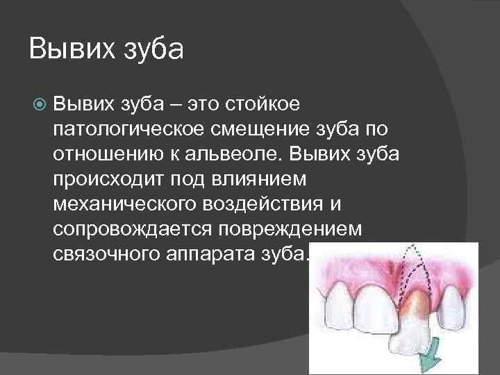 Вывих зуба – это стойкое патологическое смещение зуба по отношению к альвеоле. Вывих зуба