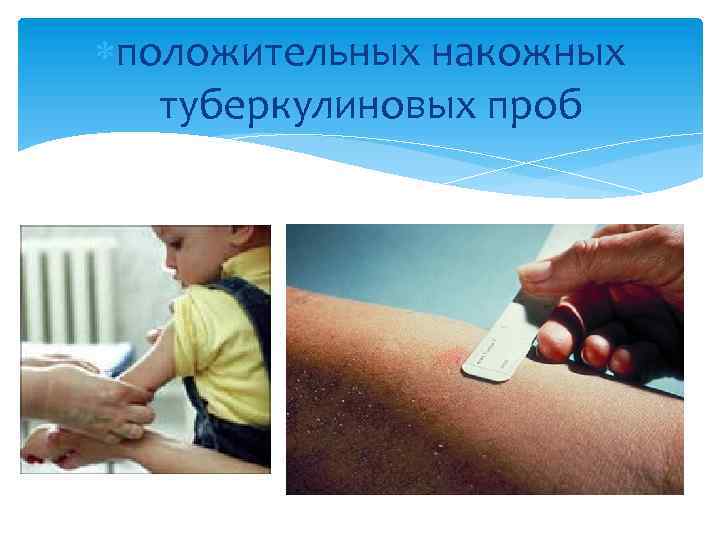  положительных накожных туберкулиновых проб 