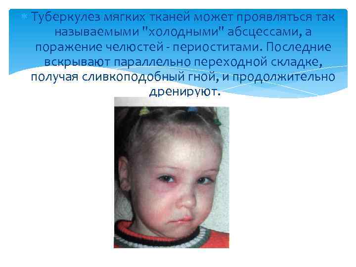  Туберкулез мягких тканей может проявляться так называемыми "холодными" абсцессами, а поражение челюстей -