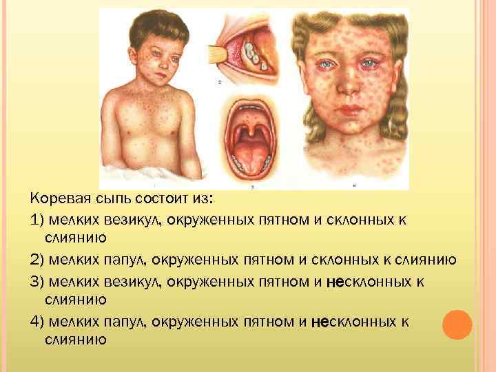 Коревая сыпь состоит из: 1) мелких везикул, окруженных пятном и склонных к слиянию 2)