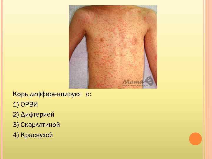 Корь дифференцируют с: 1) ОРВИ 2) Дифтерией 3) Скарлатиной 4) Краснухой 