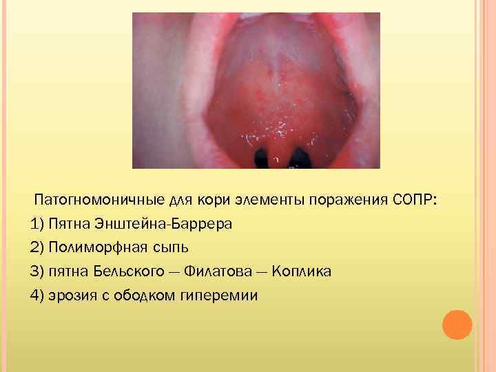Патогномоничные для кори элементы поражения СОПР: 1) Пятна Энштейна-Баррера 2) Полиморфная сыпь 3) пятна