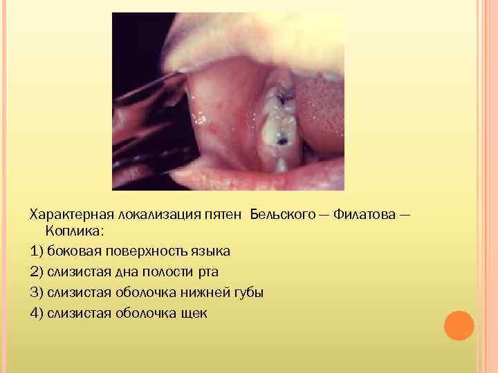Характерная локализация пятен Бельского — Филатова — Коплика: 1) боковая поверхность языка 2) слизистая