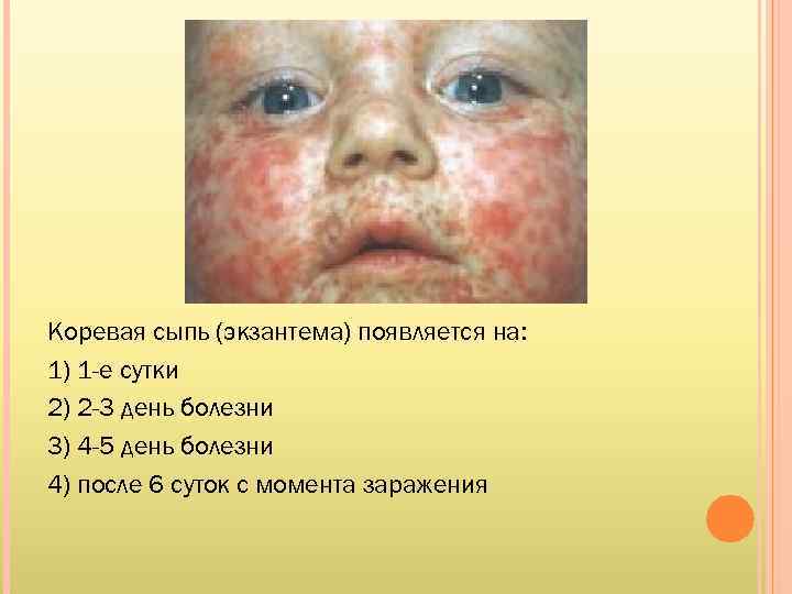 Коревая сыпь (экзантема) появляется на: 1) 1 -е сутки 2) 2 -3 день болезни