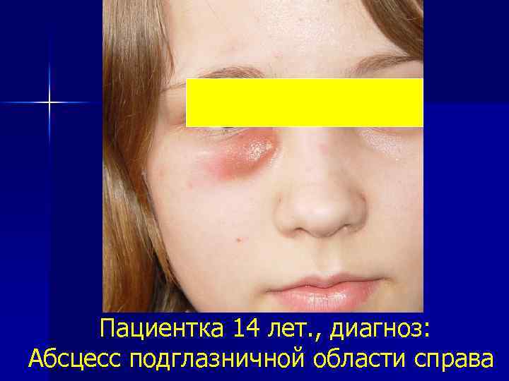 Пациентка 14 лет. , диагноз: Абсцесс подглазничной области справа 