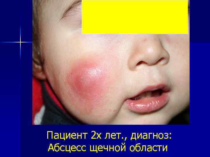 Пациент 2 х лет. , диагноз: Абсцесс щечной области 