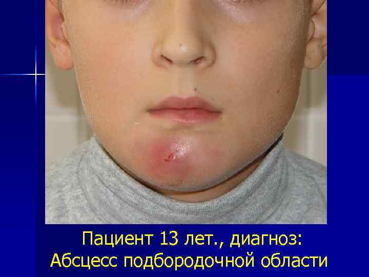 Пациент 13 лет. , диагноз: Абсцесс подбородочной области 