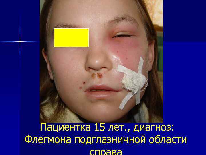 Пациентка 15 лет. , диагноз: Флегмона подглазничной области 