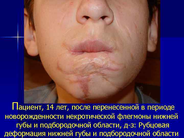 Пациент, 14 лет, после перенесенной в периоде новорожденности некротической флегмоны нижней губы и подбородочной