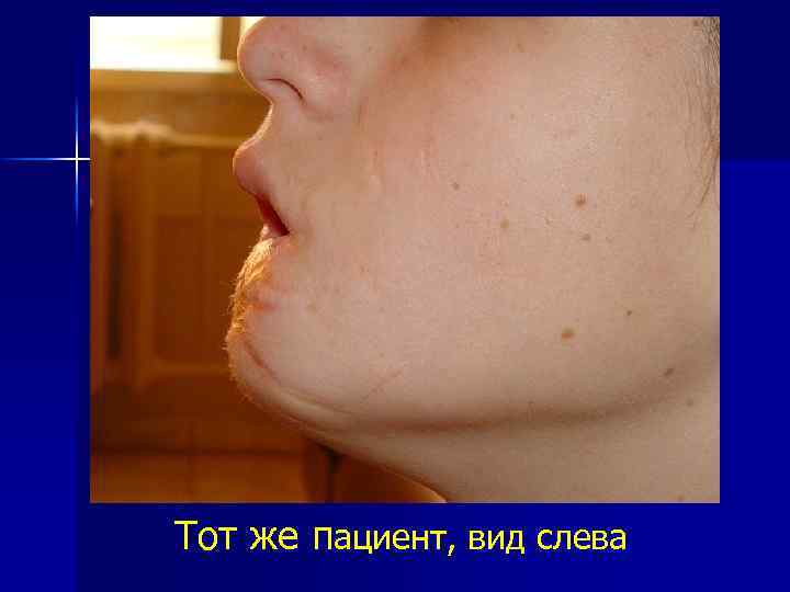 Тот же пациент, вид слева 