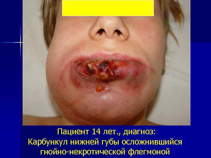 Пациент 14 лет. , диагноз: Карбункул нижней губы осложнившийся гнойно некротической флегмоной 