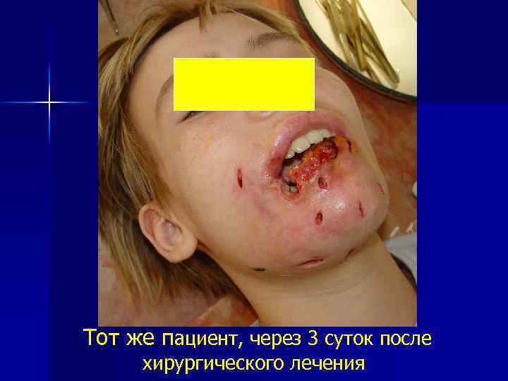 Тот же пациент, через 3 суток после хирургического лечения 