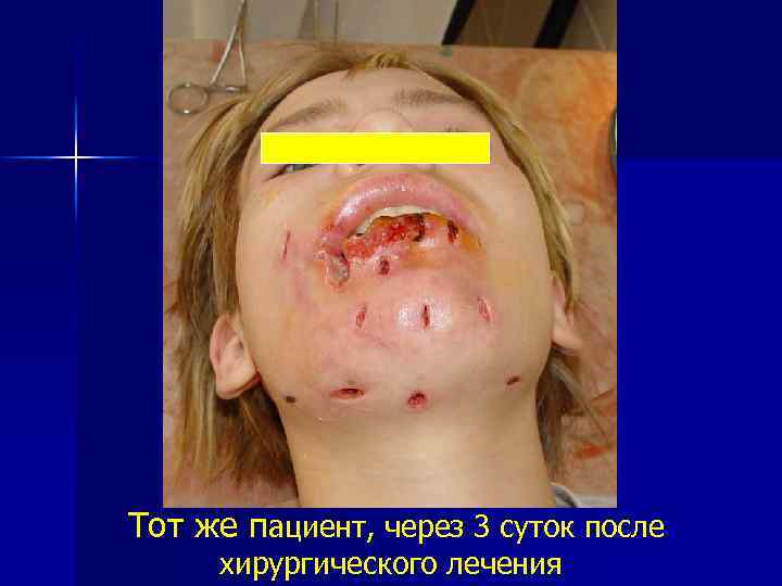 Тот же пациент, через 3 суток после хирургического лечения 
