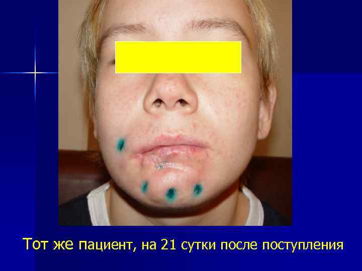 Тот же пациент, на 21 сутки после поступления 