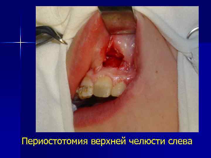 Периостотомия верхней челюсти слева 