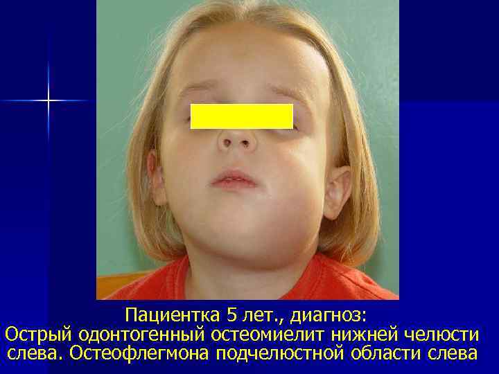 Пациентка 5 лет. , диагноз: Острый одонтогенный остеомиелит нижней челюсти слева. Остеофлегмона подчелюстной области