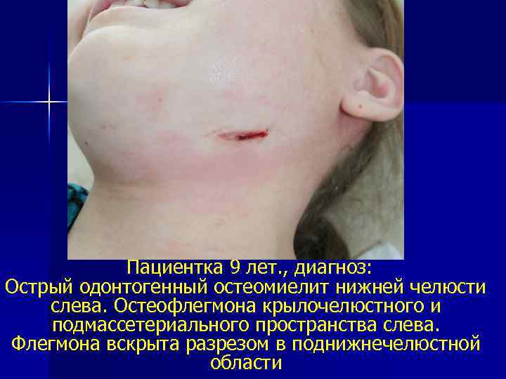 Пациентка 9 лет. , диагноз: Острый одонтогенный остеомиелит нижней челюсти слева. Остеофлегмона крылочелюстного и