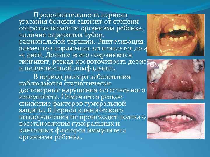 Продолжительность периода угасания болезни зависит от степени сопротивляемости организма ребенка, наличия кариозных зубов, рациональной