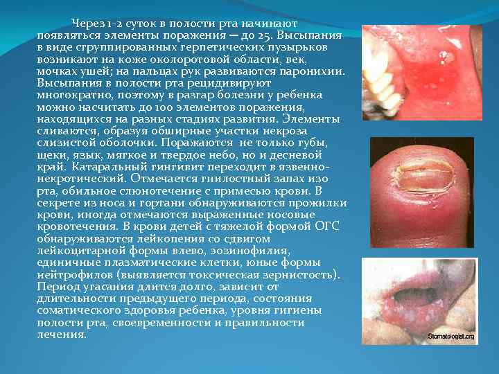 Через 1 -2 суток в полости рта начинают появляться элементы поражения ─ до 25.
