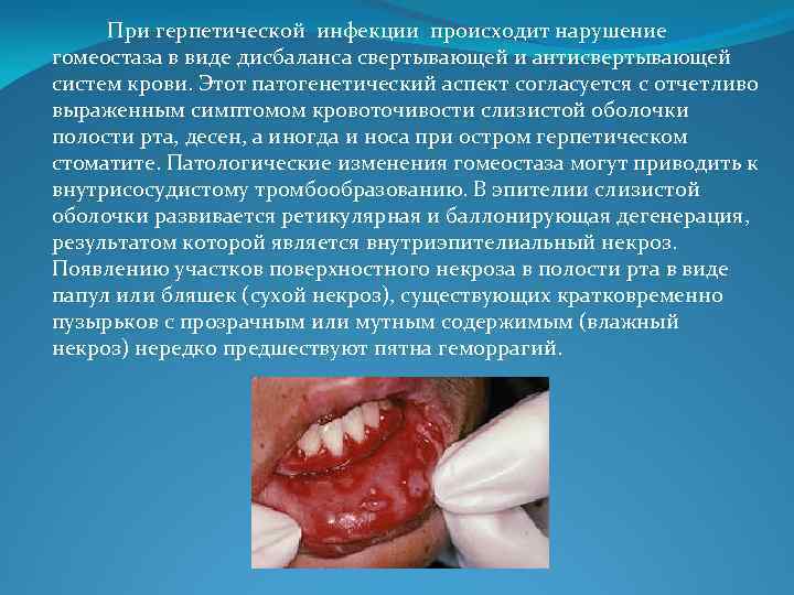 При герпетической инфекции происходит нарушение гомеостаза в виде дисбаланса свертывающей и антисвертывающей систем крови.