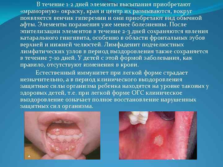 В течение 1 -2 дней элементы высыпания приобретают «мраморную» окраску, края и центр их