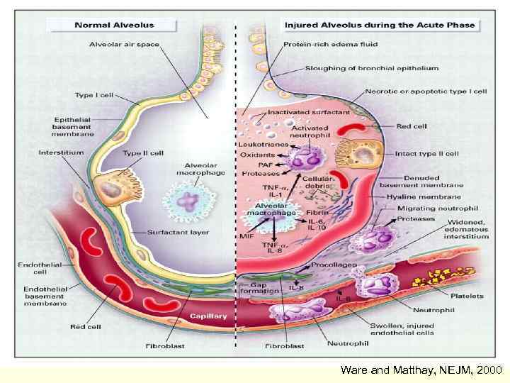 15 Ware and Matthay, NEJM, 2000 