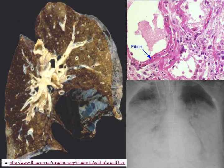 18 По: http: //www. lhsc. on. ca/resptherapy/students/patho/ards 3. htm 