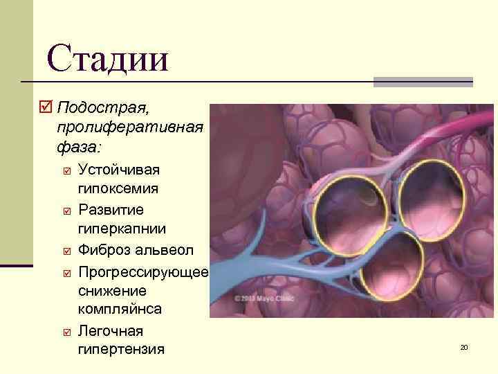 Стадии þ Подострая, пролиферативная фаза: þ þ þ Устойчивая гипоксемия Развитие гиперкапнии Фиброз альвеол