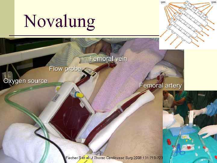 Novalung 68 Fischer S et al. J Thorac Cardiovasc Surg 2006; 131: 719 -723