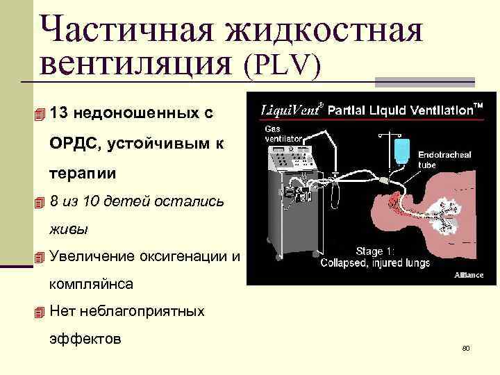 Частичная жидкостная вентиляция (PLV) 4 13 недоношенных с ОРДС, устойчивым к терапии 4 8