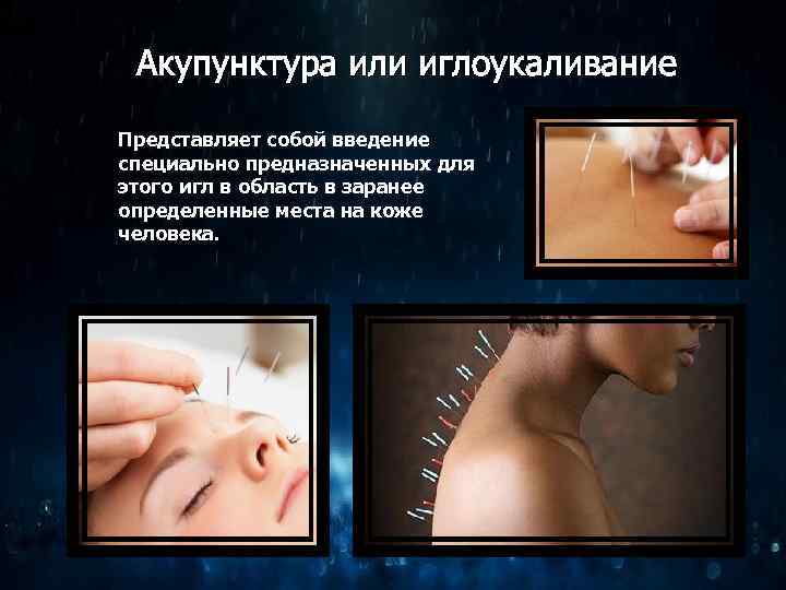 Акупунктура или иглоукаливание Представляет собой введение специально предназначенных для этого игл в область в