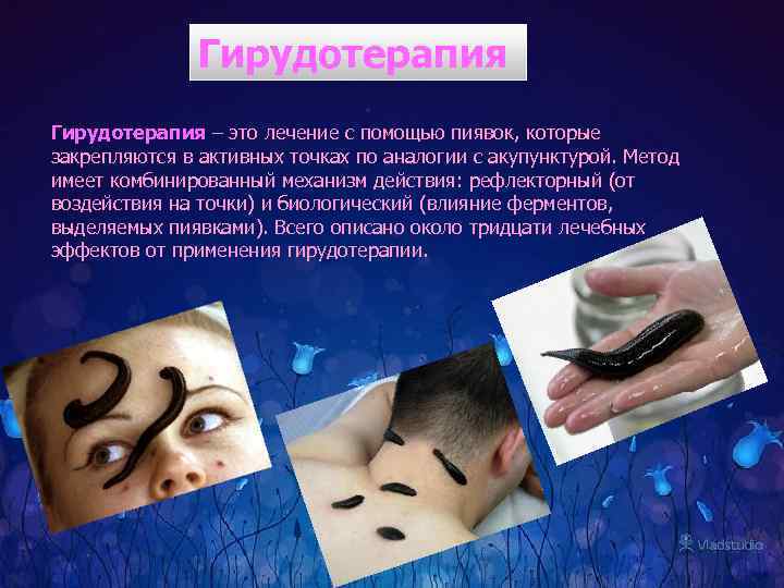 Гирудотерапия – это лечение с помощью пиявок, которые закрепляются в активных точках по аналогии