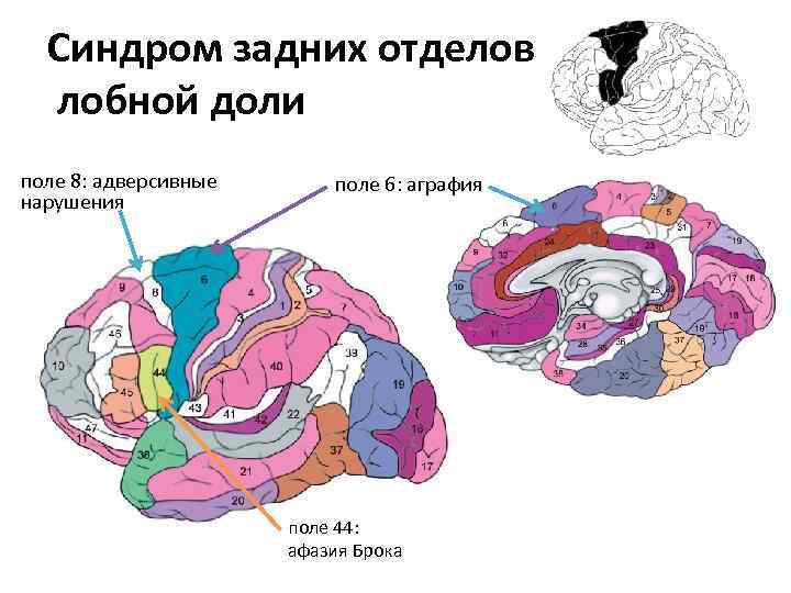 Синдром задних отделов лобной доли поле 8: адверсивные нарушения поле 6: аграфия поле 44:
