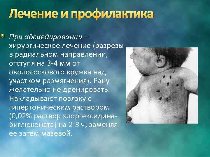 Лечение и профилактика При абсцедировании – хирургическое лечение (разрезы в радиальном направлении, отступя на