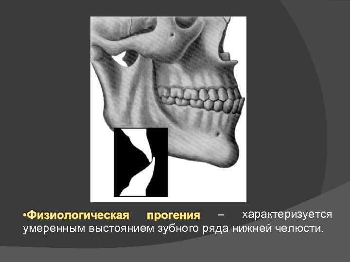  • Физиологическая прогения – характеризуется умеренным выстоянием зубного ряда нижней челюсти. 