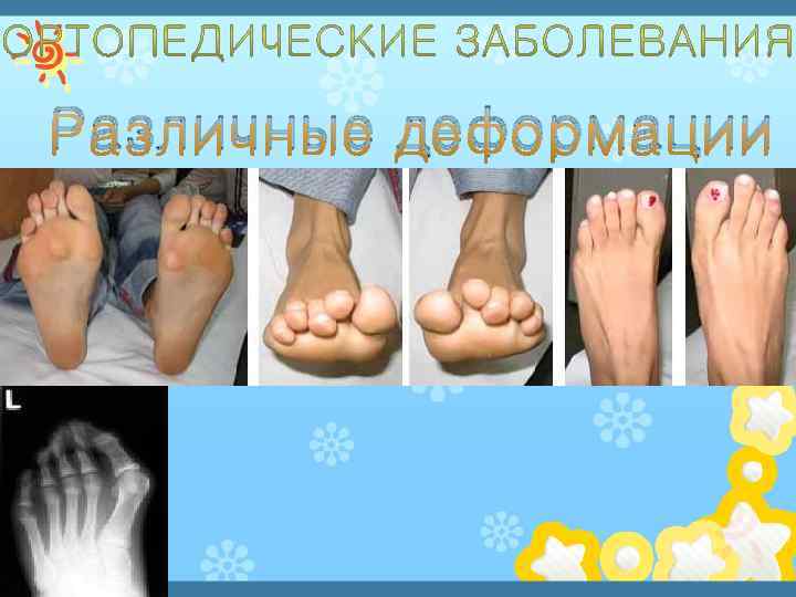 Различные деформации 