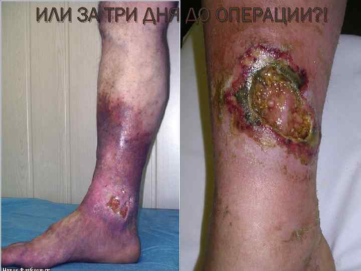 ИЛИ ЗА ТРИ ДНЯ ДО ОПЕРАЦИИ? ! 