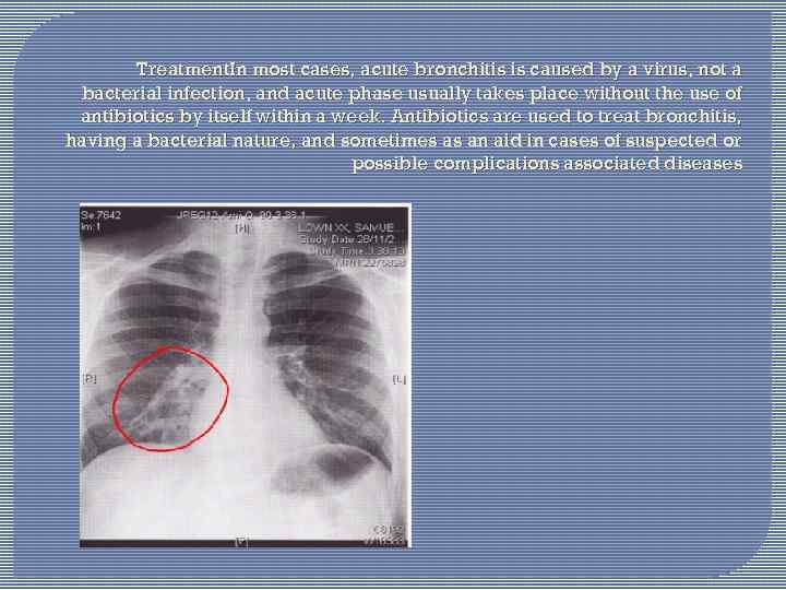 Treatment. In most cases, acute bronchitis is caused by a virus, not a bacterial