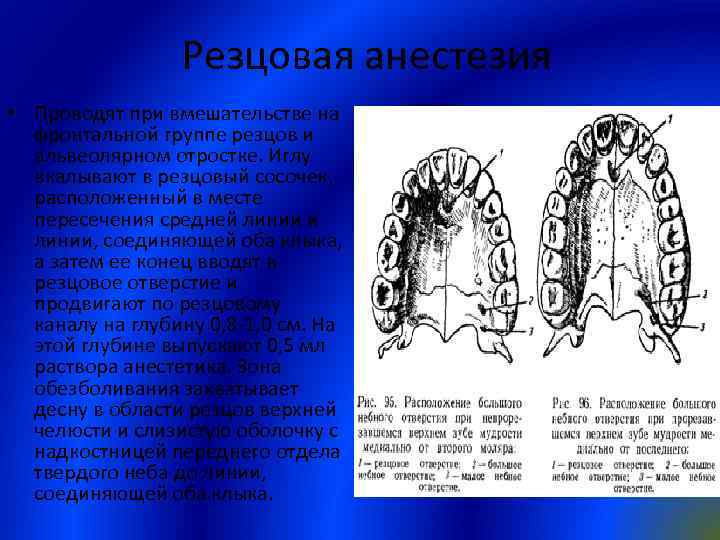 Резцовая анестезия • Проводят при вмешательстве на фронтальной группе резцов и альвеолярном отростке. Иглу