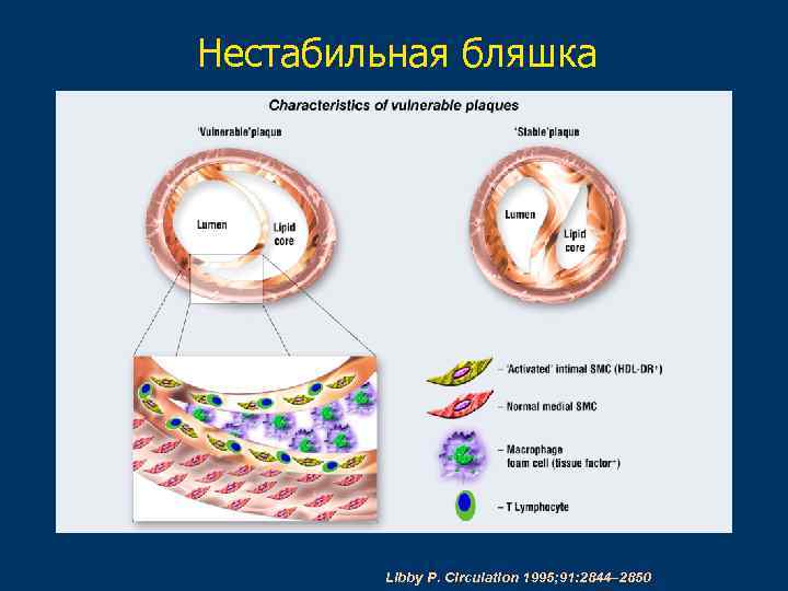 Нестабильная бляшка Libby P. Circulation 1995; 91: 2844– 2850 