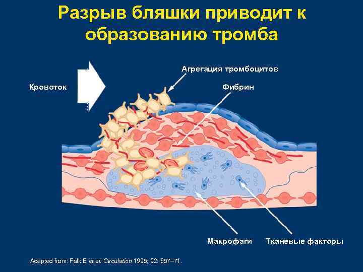 Разрыв бляшки приводит к образованию тромба Агрегация тромбоцитов Кровоток Фибрин Макрофаги Adapted from: Falk