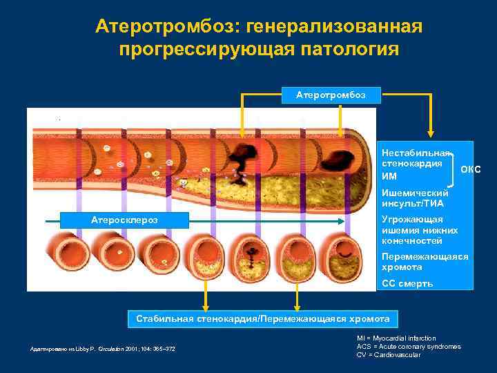 Атеротромбоз: генерализованная прогрессирующая патология Атеротромбоз Нестабильная стенокардия ИМ ОКС Ишемический инсульт/ТИА Атеросклероз Угрожающая ишемия